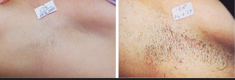 Aesthetic Lasers Supplier in the Philippines | SpectruMed