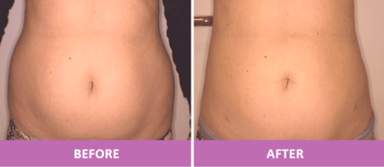  LASER LIPOSUCTION