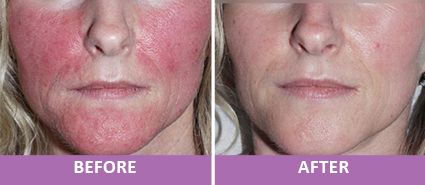 Treatment of Rosacea