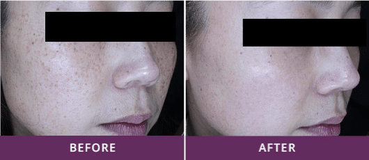 REMOVAL OF BLEMISHES & PIGMENTED LESIONS