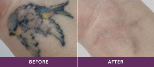 REMOVAL OF MULTICOLORED TATTOOS