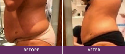 IMPROVING CELLULITE