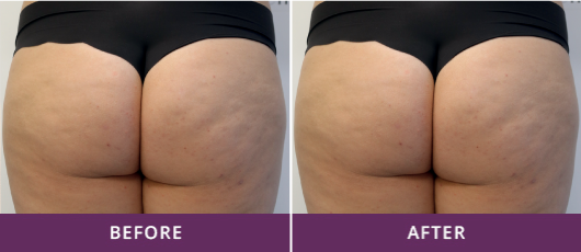 COMPREHENSIVE CELLULITE REDUCTION