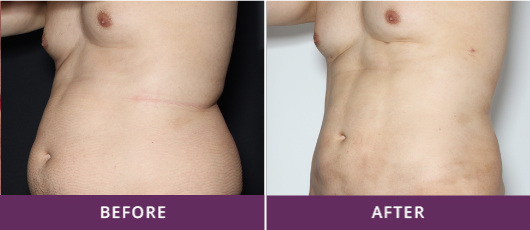 DIMINISHED STRETCHMARKS & AGE SPOTS