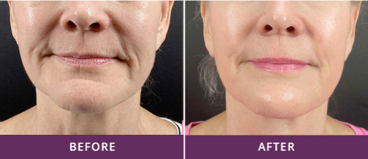 REDUCED FINE LINES & WRINKLES